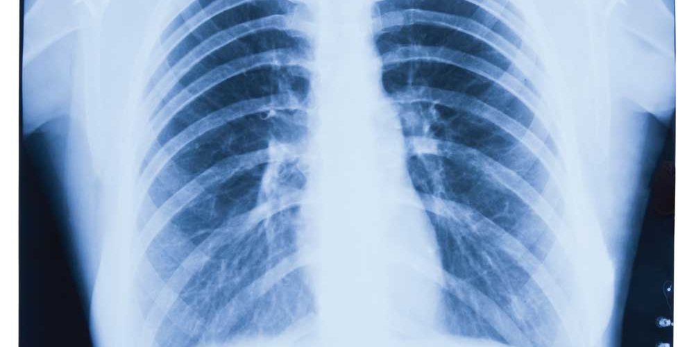 What you need to know about lung cancer screening - Mather Hospital